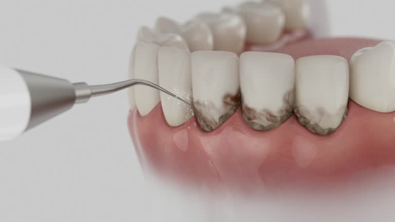 Trusted Wisdom Tooth Removal service in Montrose, CO - Dentist Open Now